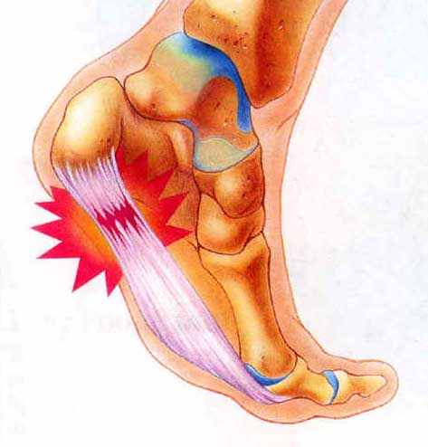 treatment of plantar fasciitis in homeopathy